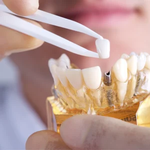 Everything Need to Know Cleaning Full Set of Dental Implants