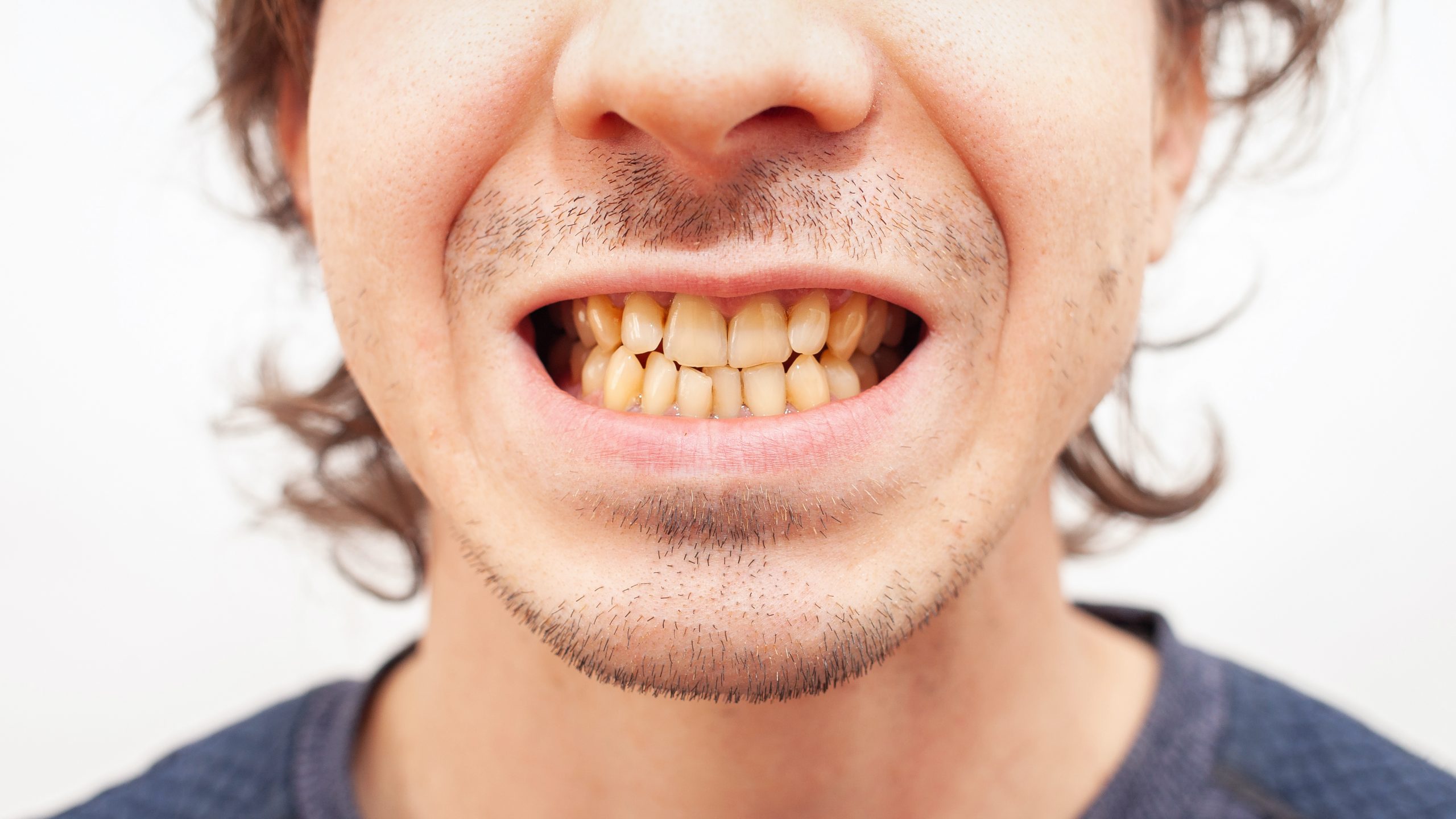 Close up portrait smile teeth man. yellow ugly teeth from smoking, alcohol, disease. Crooked dirty Close up portrait smile teeth man. yellow ugly teeth from smoking, alcohol, disease. Crooked dirty isolated