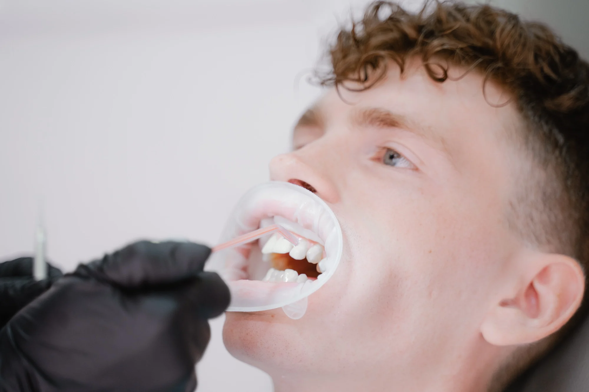 the hygienist doctor washes off the whitening solution from the teeth