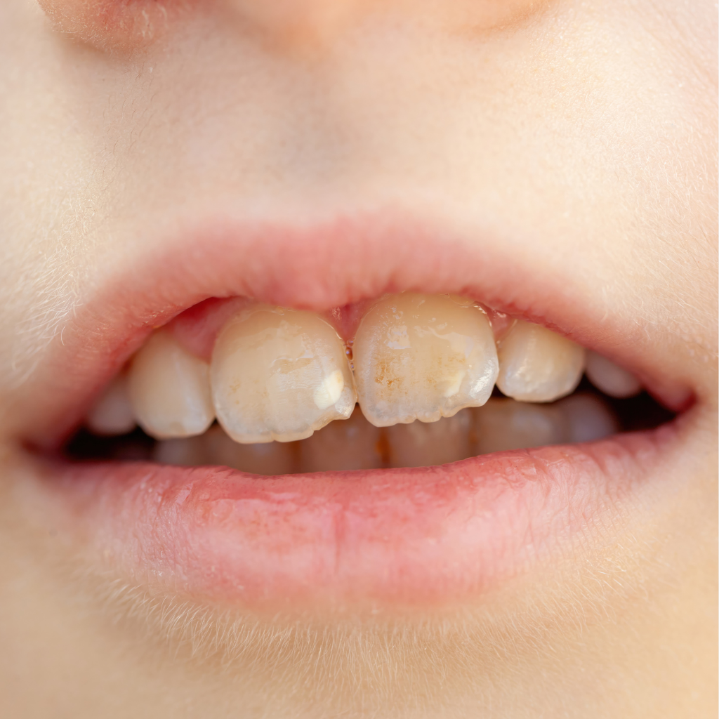 What Vitamin Deficiency Causes Brown Spots on Teeth