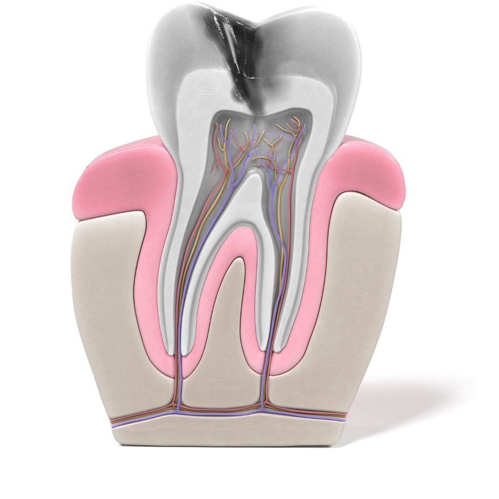 Root Canals Without the Fear