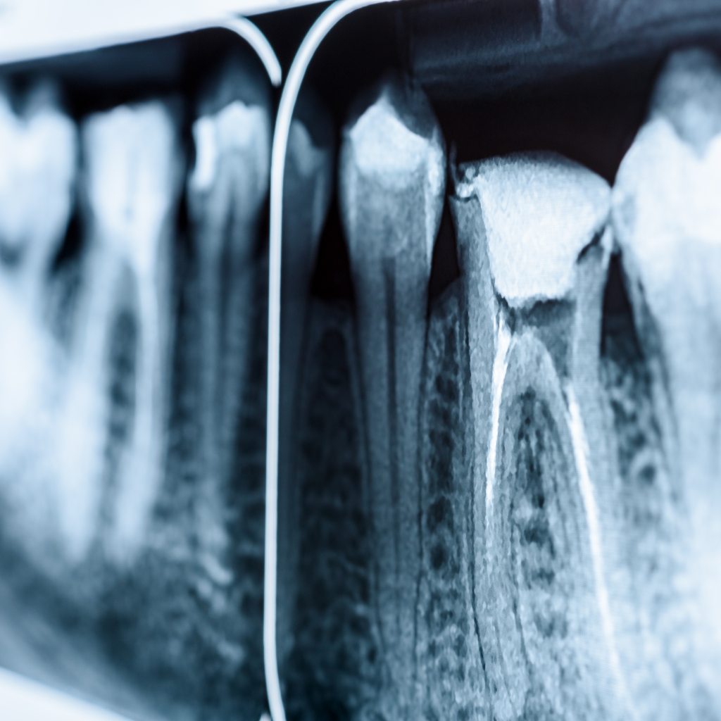 What to Do If Your Root Canal Tooth Breaks A Simple Guide